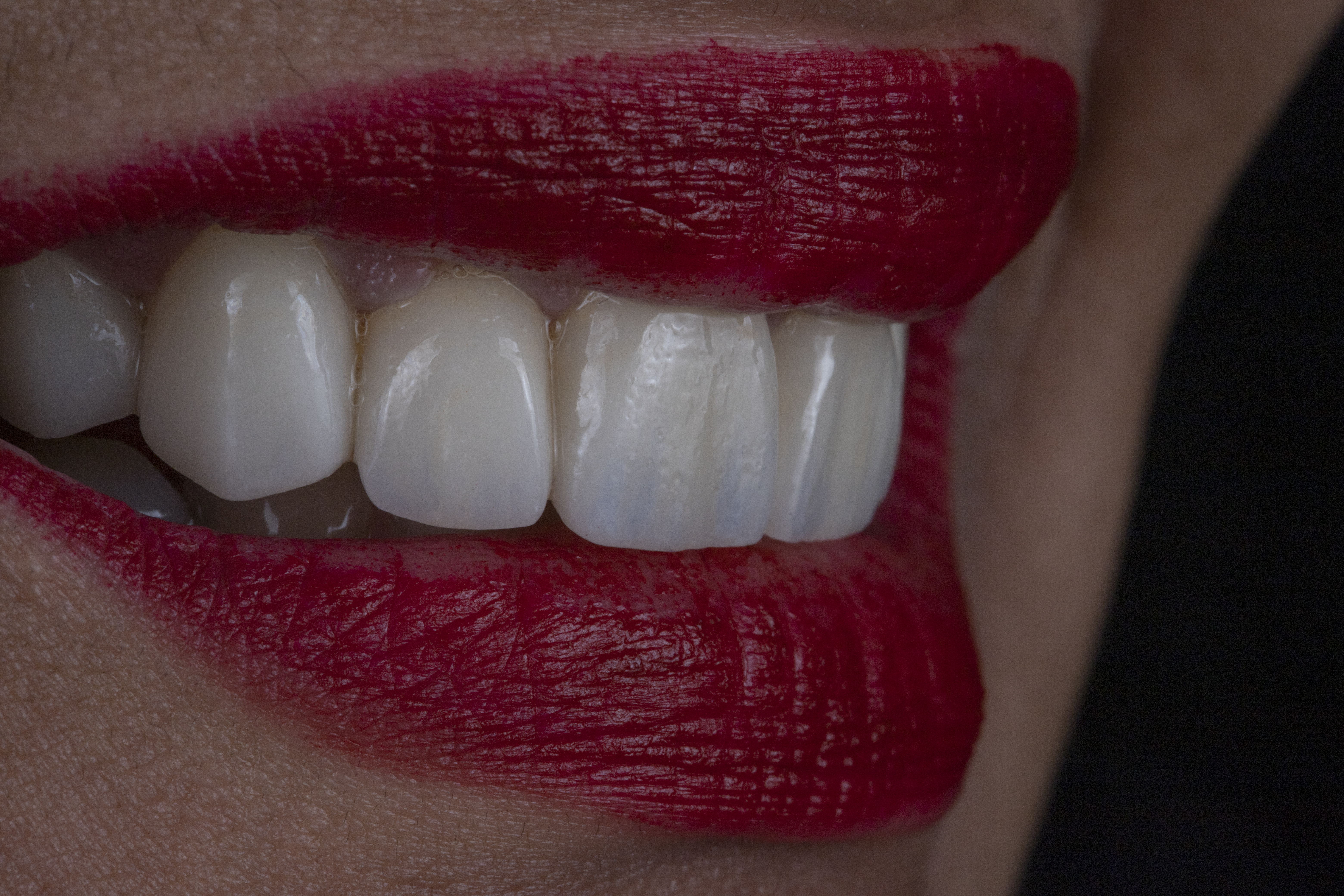 Smile Makeover Before and After